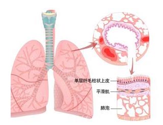 运动性性哮喘的治疗费用