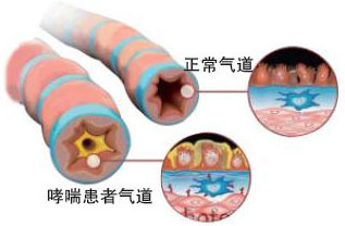 过敏性哮喘具体有什么症状